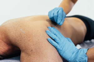 advanced health dry needling